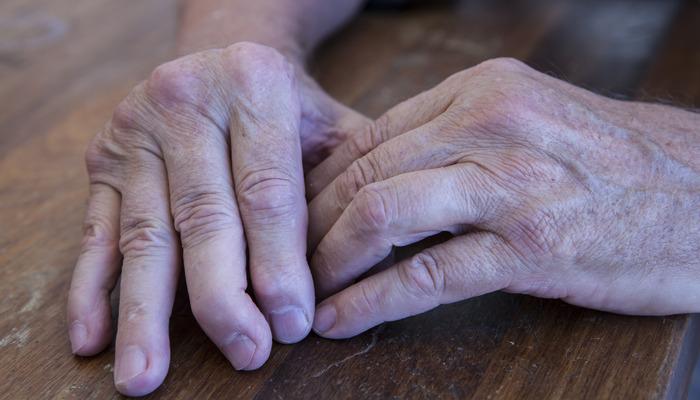Psoriatik artrit nedir?  Psoriatik artritin belirtileri ve tedavisi