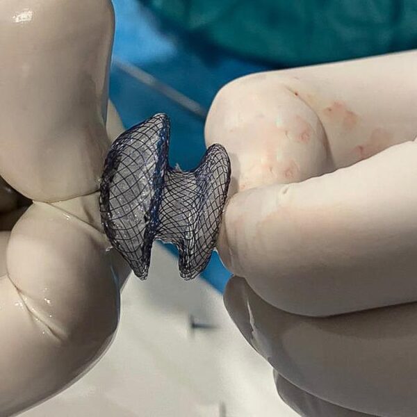 Çarpıntı, nefes darlığı ve yorgunluk varsa dikkat! Kalp deliği artık kapalı yöntemle tedavi edilebiliyor